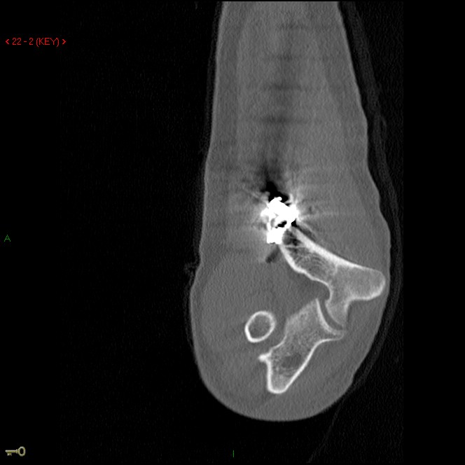 Figure 4 for case Re-fracture distal humerus
